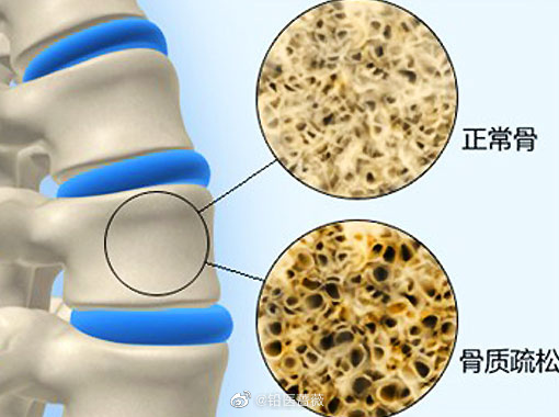 专家提醒40岁后注重骨密度检测筛查 光靠补钙不能预防骨质疏松
